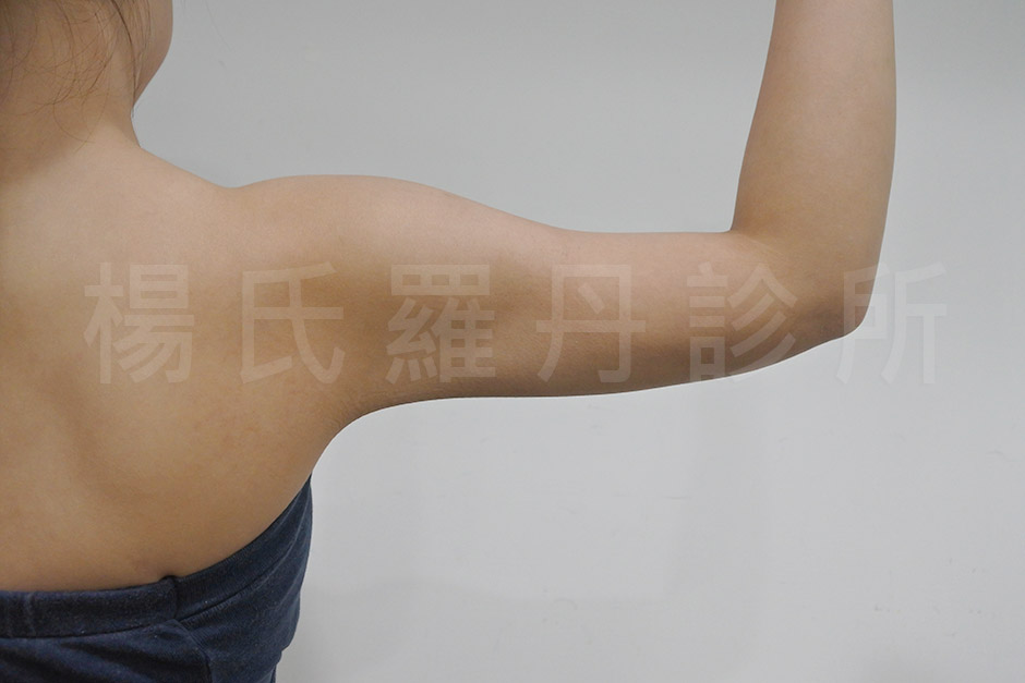 雷射減脂
